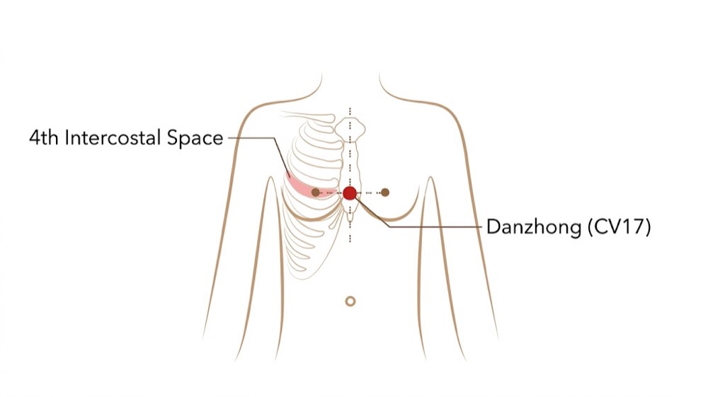 Location of Danzhong CV-17 acupoint, on the midline of the breastbone, on the bone