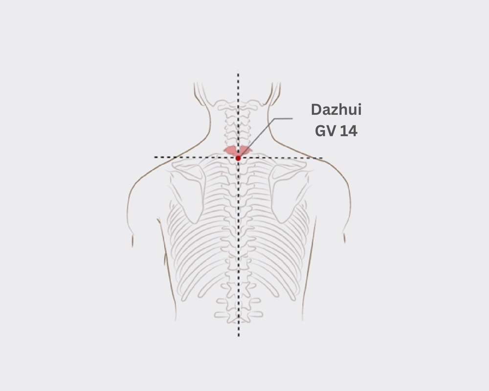 Location of Dazhui GV-14 acupoint, on the midline below the big bump at the base of the neck